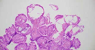 Microfotografía (x10 aumentos) donde se observa una marcada linfangiectasia intestinal y una duodenitis linfoplasmocitaria